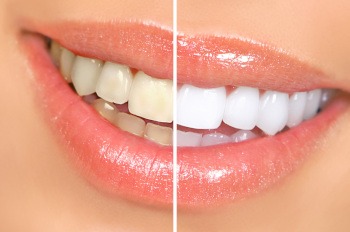 Closeup of a smile in sparkly gloss halved to show before/after teeth whitening