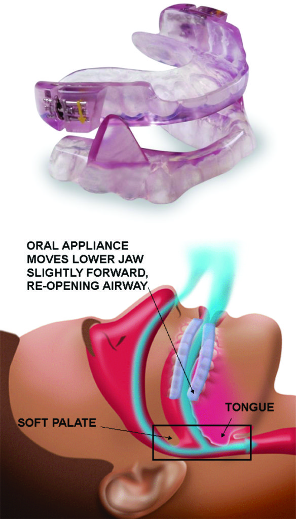 Oral Appliance For Sleep Apnea Advanced Dental Concepts Blog 9862